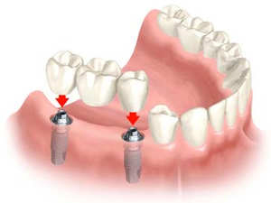 Denti x protesi resina 3 strati GOLDENT bocca 4 File dentista odontotecnico 